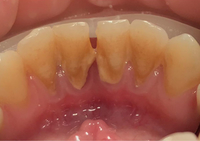 Комплексный подход к удалению зубного налёта