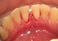 Комплексный подход к удалению зубного налёта