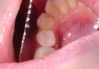 Лечение зуба